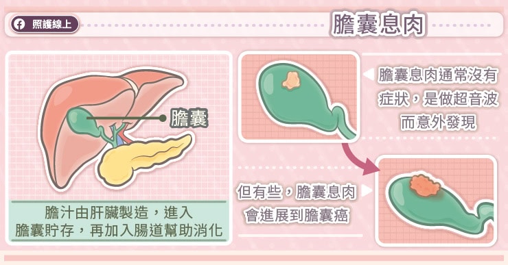 膽囊息肉